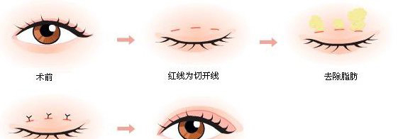 男生怎么把单眼皮变成双眼皮技巧